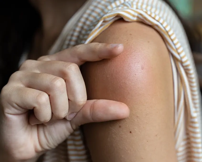 Che cos’è l’immunoterapia allergene specifica?